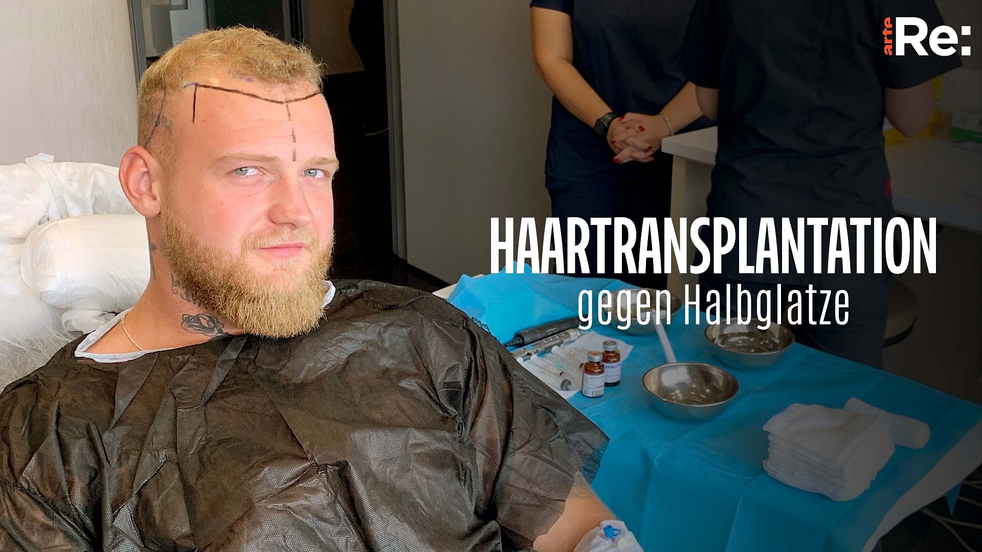 Re: Haartransplantation gegen Halbglatze
