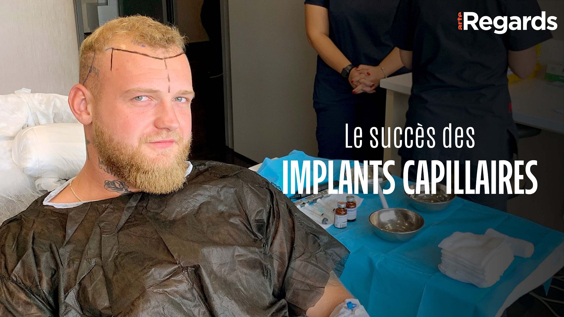 ARTE Regards - Le succès des implants capillaires